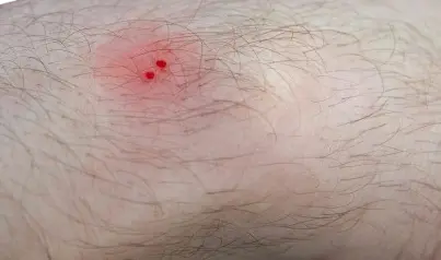 বিষাক্ত সাপের কামড়ের লক্ষণ